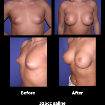 Breast-Augmentation23