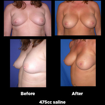 Breast-Augmentation25