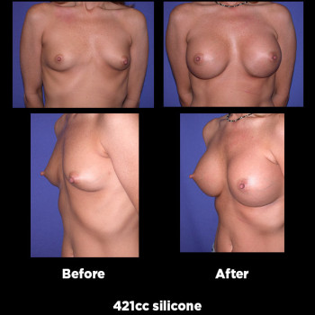 Breast-Augmentation26