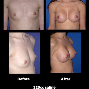 Breast-Augmentation27