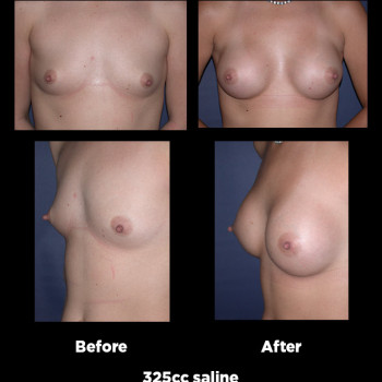 Breast-Augmentation28