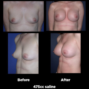 Breast-Augmentation30