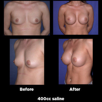 Breast-Augmentation31