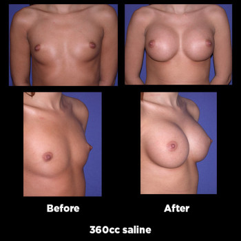 Breast-Augmentation32