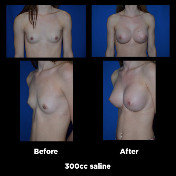 Breast-Augmentation33