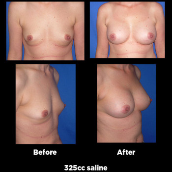 Breast-Augmentation34