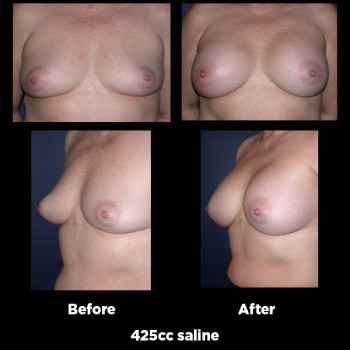 Breast-Augmentation35
