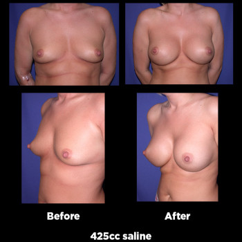 Breast-Augmentation38