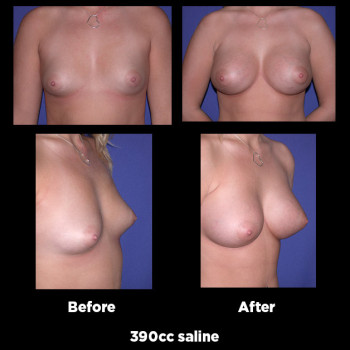Breast-Augmentation40
