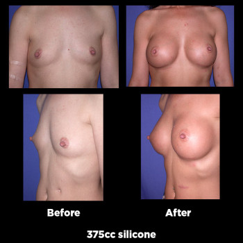 Breast-Augmentation41