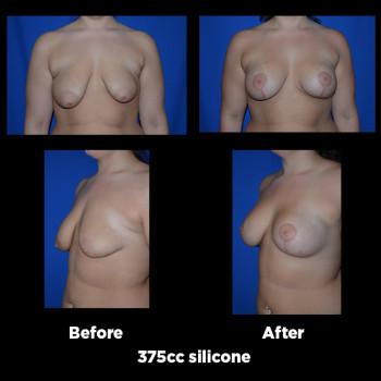 Breast-Lift-(Mastopexy)12