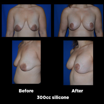 Breast-Lift-(Mastopexy)21
