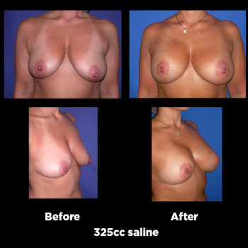 Breast-Lift-(Mastopexy)22