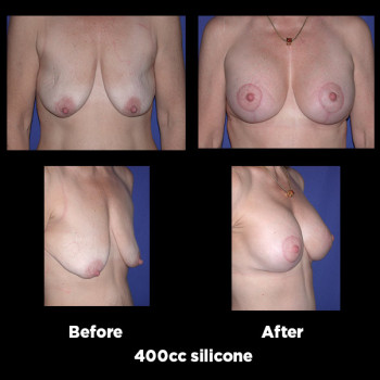 Breast-Lift-(Mastopexy)25