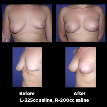 Breast-Lift-(Mastopexy)26