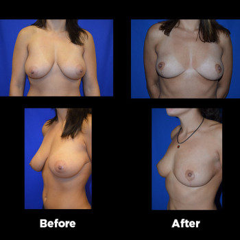 Breast-Reduction11
