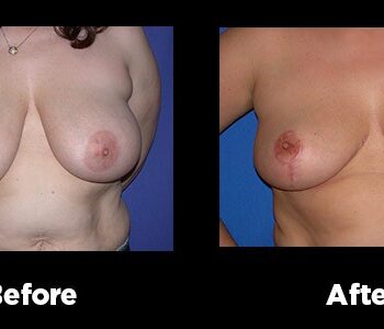 Breast-Reduction12