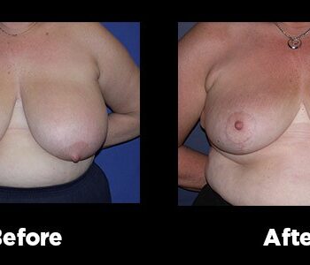 Breast-Reduction13