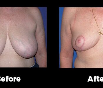 Breast-Reduction14