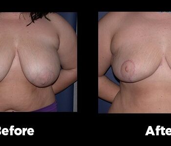 Breast-Reduction15
