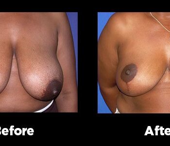 Breast-Reduction16