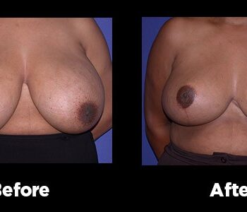 Breast-Reduction17