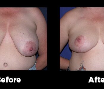 Breast-Reduction18