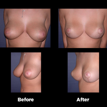 Breast-Reduction19