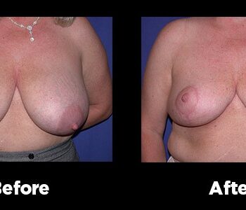 Breast-Reduction20