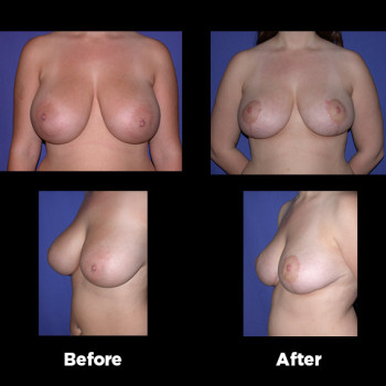 Breast-Reduction21