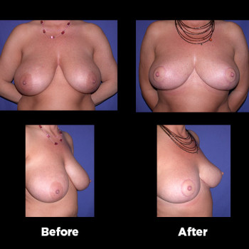 Breast-Reduction22