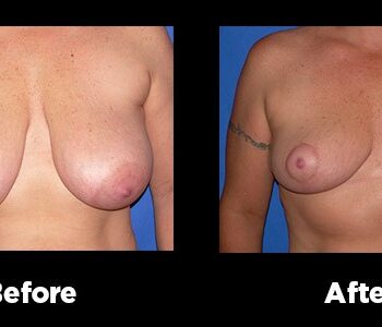 Breast-Reduction23
