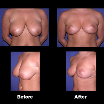 Breast-Reduction24
